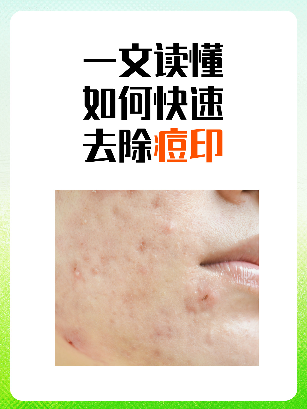 痘痘如何去除效果好（痘痘怎么去除效果好不留痘印）